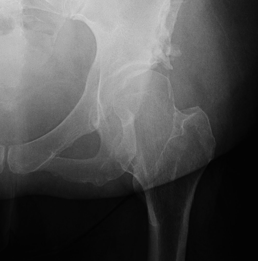 Shelf Osteotomy